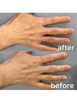 ハンドケアビフォーアフター
