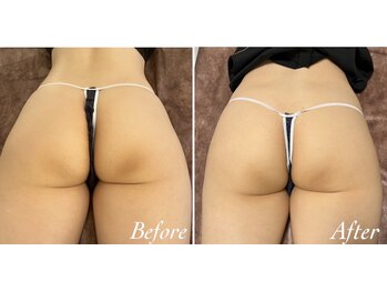 ピリナ 名古屋/ヒップローズドメーラピーリング