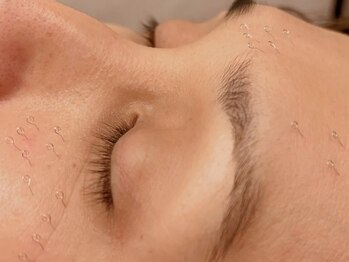 デルタエヌピー63+(δnp63+)/お客様施術例【小顔/薬院/福岡】