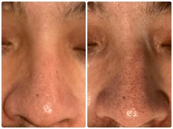 アレーズファイブフォー(A’LAISE54)/毛穴改善