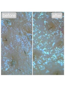 エイル ビューティ ホヌ(EIL beauty Honu)/マイクロスコープ画像