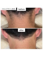 ポノ(Pono)/うなじデザイン脱毛