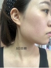 エステティック レイビス 池袋店(RAYVIS)/ハーブピーリング5日後朝