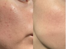 ビジュー(BIJOU)/プラピール