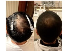 シャラ(shara)/つむじ薄い髪の毛