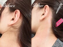 ピミル(PIMIL)/うなじ脱毛