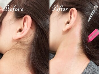 ピミル(PIMIL)/うなじ脱毛