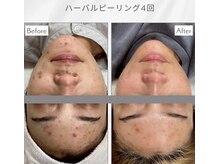 イーズサロン 西大寺店/天然ハーブピーリング肌質改善