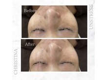 シャルムパリス(charme paris)/敏感肌にも◎１回の施術変化