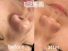 ヴィセラ(Vicella)/毛穴洗浄でツルツル！