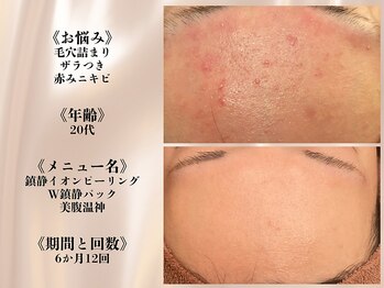 アクール(Accueil)/【ニキビ・赤み】