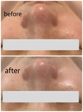 サロン カレア(Salon Kalea)/毛穴洗浄×ハーブピーリング