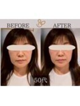 チョコバリ 錦糸町店(chocobari)/小顔×リフトアップ(美容鍼)20代