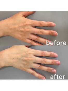 オテテ アイアンドハンド(otete eye&hand)/ハンドケアビフォーアフター