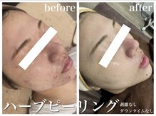 レア 姫路店(le'a)/回数を重ねるたびに"美肌"へ