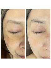 ヴィアス(VIAS)/プラズマフェイシャル　6回目