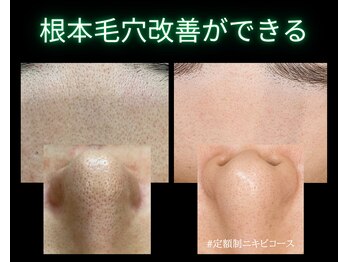 リオル(Rior)の写真/【見た目でわかる毛穴レス肌に】洗浄・ピーリング・熱のトリプル施術でザラつき、開き毛穴を根本改善◎