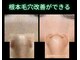 リオル(Rior)の写真/【見た目でわかる毛穴レス肌に】洗浄・ピーリング・熱のトリプル施術でザラつき、開き毛穴を根本改善◎