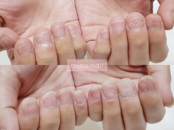 深爪矯正before&after