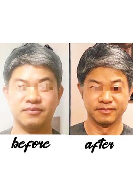 ラグラン銀座メディカルエステ 高輪ゲートウェイ店/男性の小顔+毛穴ケア