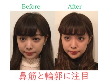 ラプリ 福岡天神店(Raplit)/隆鼻+輪郭・小顔矯正 美鼻/小顔