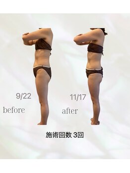 カリス(charis)/施術回数３回