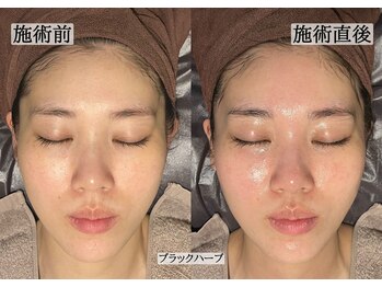 サロンドカメリア(salon de Camellia)/ブラックハーブ直後のお肌