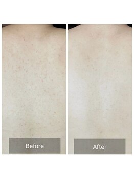 アーユルヴェーダアンドアロマエステ アユス(AYUS)/ハーブピーリング背中