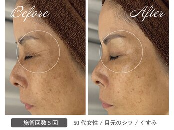 カシェボーテ(CACHE BEAUTE)/目元シワケア/黒ずみもお任せ