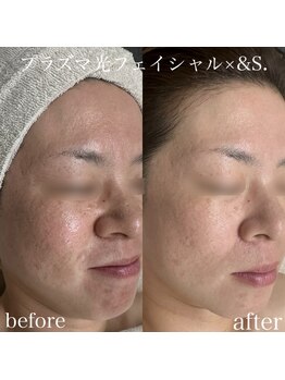 アンドエス(&S.)/均一肌へ!プラズマ光☆