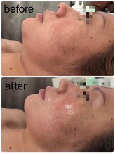 アズ(Azu)/RED SHOT