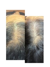 デピラード(Depilado)/本気の育毛！頭皮エイジング