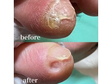 巻き爪補正店 越谷店/副爪(小指の横にできる硬い角質)