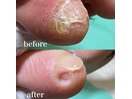 副爪(小指の横にできる硬い角質)