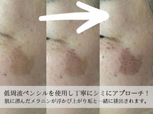モラン(MO.RAN)/低周波ペンシルでシミが浮き出る