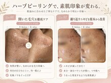 プリュボーテ(Pul Beaute)の雰囲気（心地よいチクチクが肌を育てる♪ 毛穴｜ニキビ｜凹凸肌｜色沈）