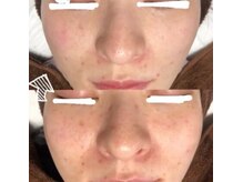 エム(M)/1回でのBefore After◎シミケア