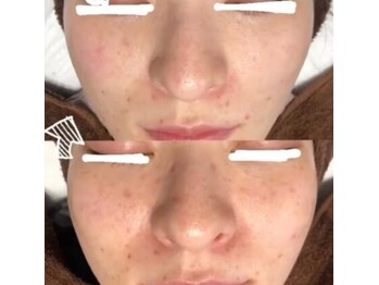 エム(M)/1回でのBefore After◎シミケア