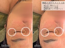 フェイシャルヴィム(FACIAL VIM)/陶肌トリートメントでシワケア