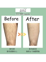 ナガオカ 今朝白店(nagaoka)/脚の脱毛/BeforeAfter 　