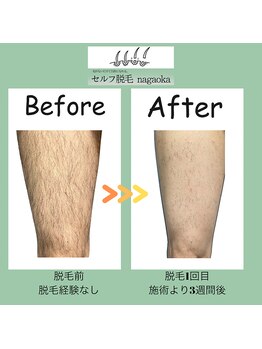 ナガオカ 今朝白店(nagaoka)/脚の脱毛/BeforeAfter