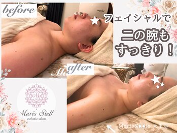 マリスステラ 天王寺(MarisStella)/フェイシャルで二の腕も！