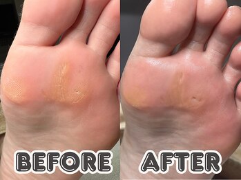 ポドロ ウィズ ニコルル 大阪天満店(PoDoLo with Nicolulu)/【足裏の魚の目】フットケア大阪