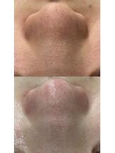 ラルガ 城野店(Raruga)/毛穴洗浄