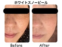 ラディアント たまプラーザの雰囲気（スノーピールはシミケアだけじゃない！毛穴を引締め若見え効果も）