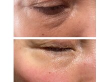 世界一のたるみケア！最先端技術！