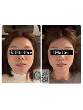 キュープ 浜松店(Qpu)/小顔矯正でお顔を一回り小さく！