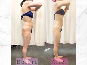 パラディ(PARADIS)/ハイパーナイフ/シェイプ/コルギ