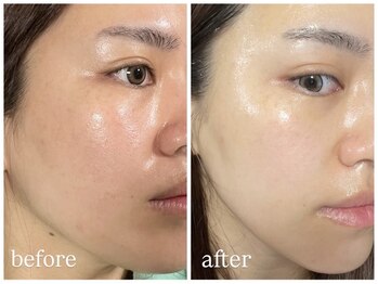クリア(CLEAR)の写真/高濃度炭酸×高出力光フォト×毛穴洗浄でスペシャルエイジングケア