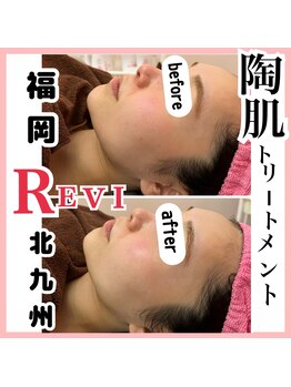 ハピネス(Hapiness)/酵素300REVI陶肌トリートメント